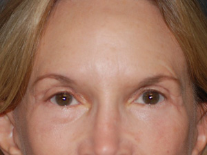 After Brow Lift