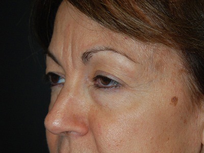 Before Eyelid Surgery