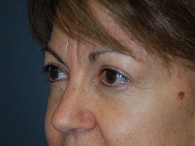 After Eyelid Surgery