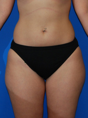 Before Liposuction