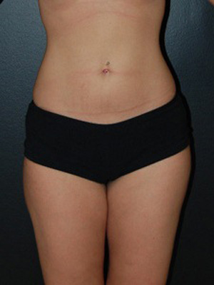 After Liposuction