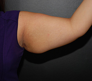Arm Lift Before Photo by Steely Plastic Surgery in Houston, TX