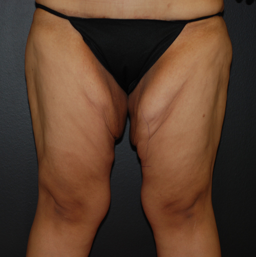 Before Augmentation