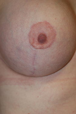 breast lift scar