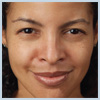 BA-Botox-Before1 After Botox Houston