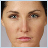 BA-Botox-Before1 After Botox Houston
