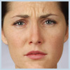 BA-Botox-Before1 Before Botox Houston