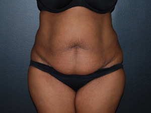 Before Tummy Tuck Augmentation