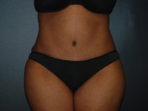 After Tummy Tuck Augmentation