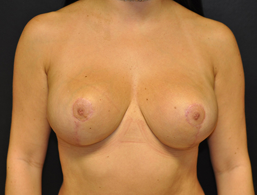 Breast Implant Removal After