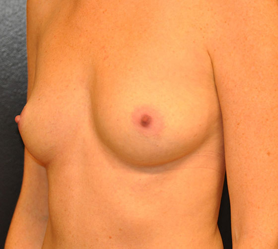 Breast Augmentation Surgery Results Houston