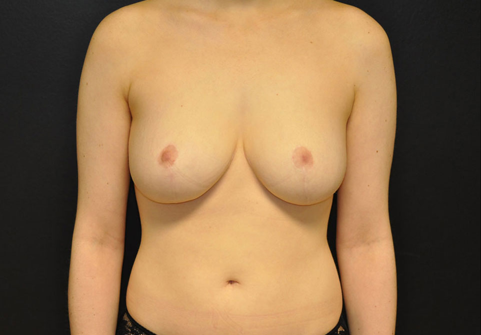 Breast Reduction Results Houston