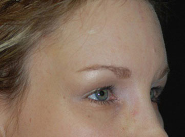 After Brow Lift
