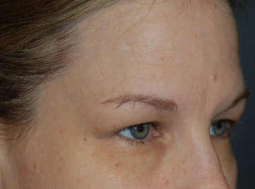 Before Brow Lift