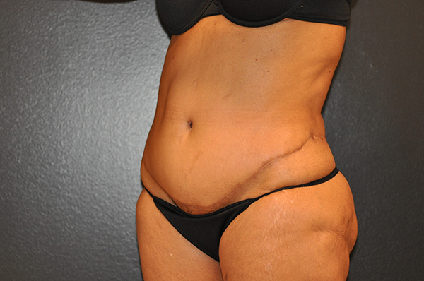 Revision Tummy Tuck Before and After Photo by Dr. Steely in Houston, TX