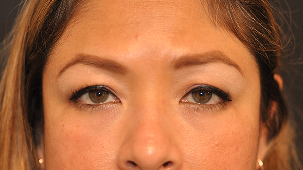 Eyelid Surgery Before and After Photo by Dr. Steely in Houston, TX