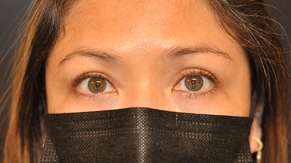 Eyelid Surgery Before and After Photo by Dr. Steely in Houston, TX