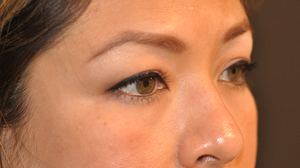 Eyelid Surgery Before and After Photo by Dr. Steely in Houston, TX