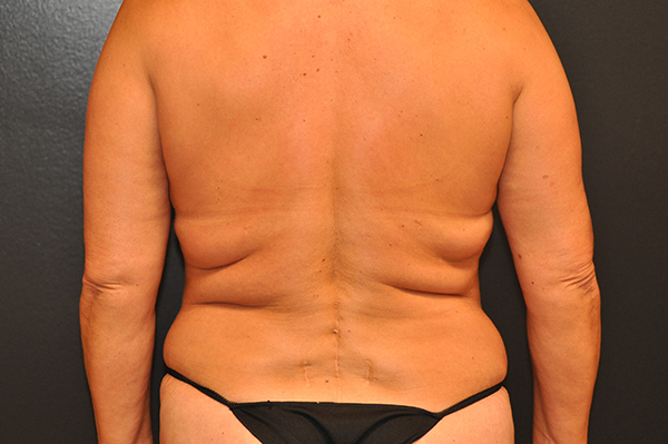 Upper Back Lift Before and After Photo by Dr. Steely in Houston, TX