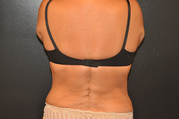 Upper Back Lift Before and After Photo by Dr. Steely in Houston, TX