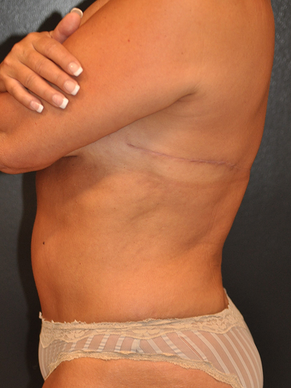 Upper Back Lift Before and After Photo by Dr. Steely in Houston, TX