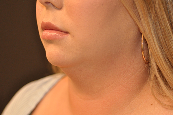 Liposuction of Chin & Jawline Before and After Photo by Dr. Steely in Houston, TX