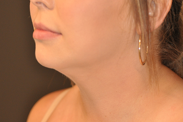 Liposuction of Chin & Jawline Before and After Photo by Dr. Steely in Houston, TX