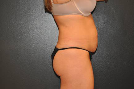 Tummy Tuck Before and After Photo by Dr. Steely in Houston, TX