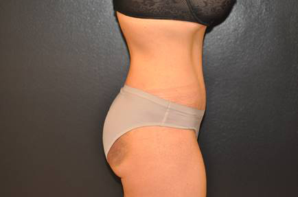 Tummy Tuck Before and After Photo by Dr. Steely in Houston, TX