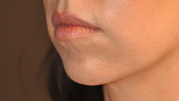 Dermal Filler Before and After Photo by Dr. Steely in Houston, TX