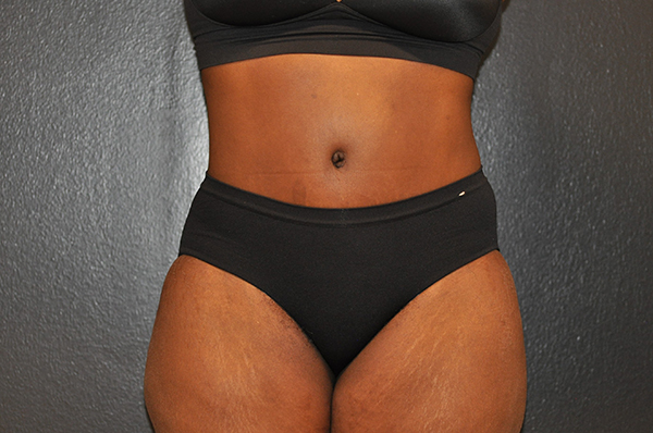 Tummy Tuck Before and After Photo by Dr. Steely in Houston, TX