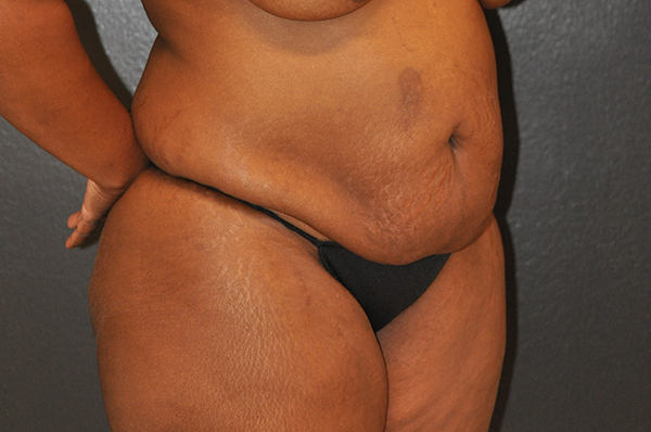 Tummy Tuck Before and After Photo by Dr. Steely in Houston, TX