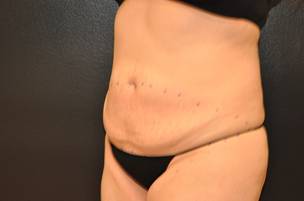 Tummy Tuck Before and After Photo by Dr. Steely in Houston, TX