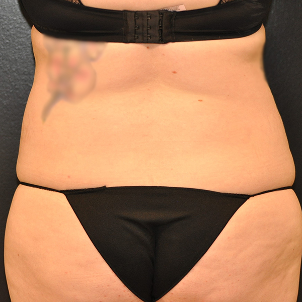 Tummy Tuck Before and After Photo by Dr. Steely in Houston, TX