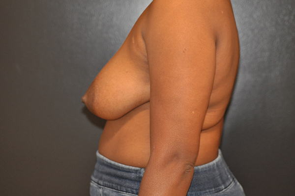 Breast Lift with Implants Before and After Photo by Dr. Steely in Houston, TX