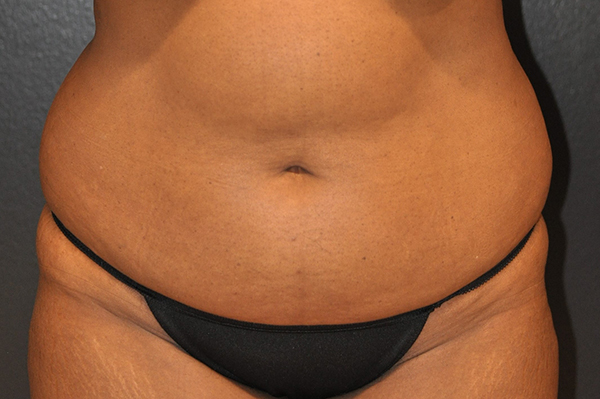 Tummy Tuck Before and After Photo by Dr. Steely in Houston, TX