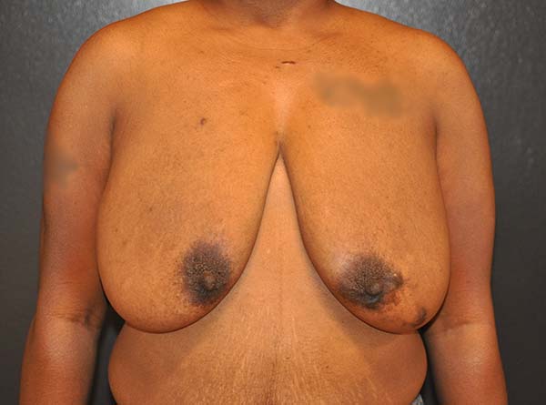 Breast Lift with Impants Before and After Photo by Dr. Steely in Houston, TX