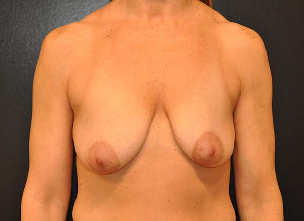 Breast Lift with Impants Before and After Photo by Dr. Steely in Houston, TX