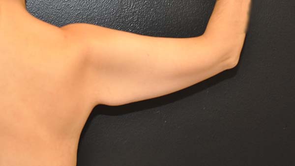 34 year old woman lost over 65 lbs with diet/ exercise and requested rejuvenation of her arms Photos on the right are 4 months after Extended Arm Lift with Liposculpting by Dr. Steely