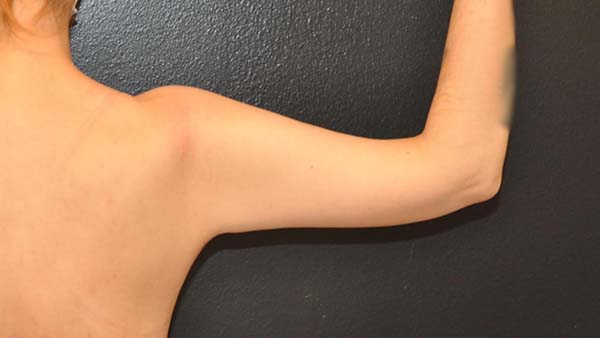 34 year old woman lost over 65 lbs with diet/ exercise and requested rejuvenation of her arms Photos on the right are 4 months after Extended Arm Lift with Liposculpting by Dr. Steely