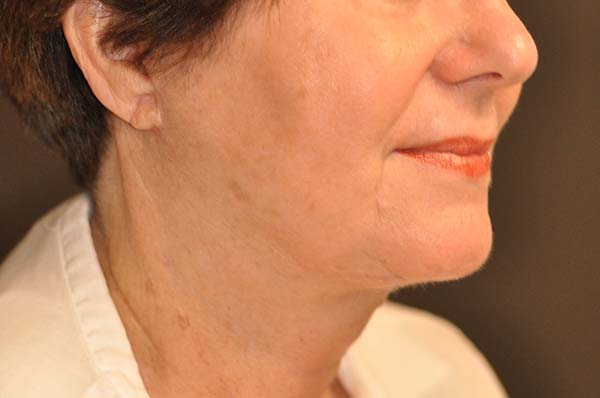 Facelift / Necklift Before and After Photo by Dr. Steely in Houston, TX