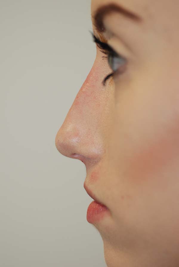Dermal Filler Before and After Photo by Dr. Steely in Houston, TX