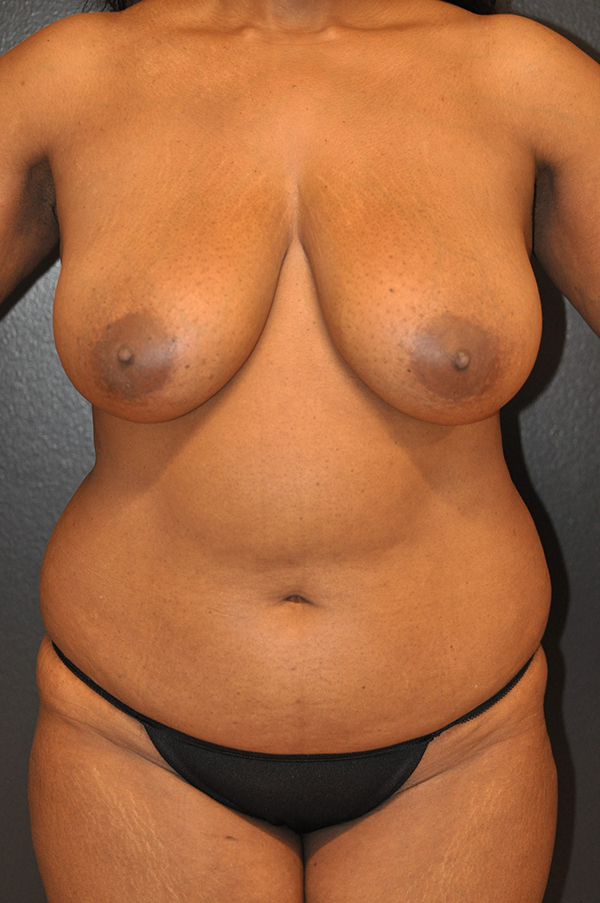 Tummy Tuck Before and After Photo by Dr. Steely in Houston, TX