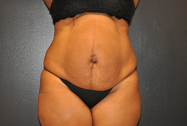 Tummy Tuck Before and After Photo by Dr. Steely in Houston, TX