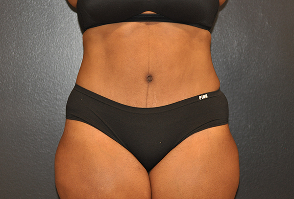 Tummy Tuck Before and After Photo by Dr. Steely in Houston, TX