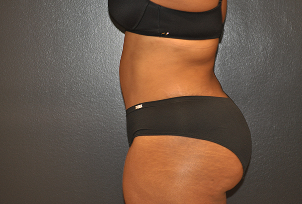 Tummy Tuck Before and After Photo by Dr. Steely in Houston, TX