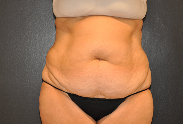 Tummy Tuck Before and After Photo by Dr. Steely in Houston, TX