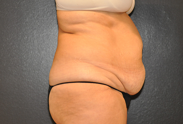 Tummy Tuck Before and After Photo by Dr. Steely in Houston, TX