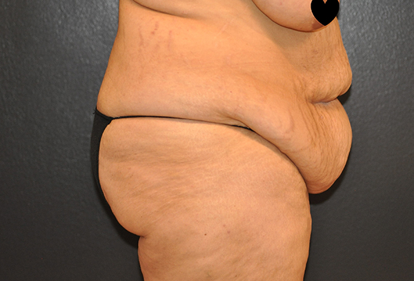 Tummy Tuck Before and After Photo by Dr. Steely in Houston, TX