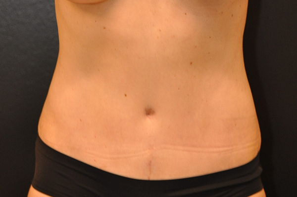 Mini Tummy Tuck Before and After Photo by Dr. Steely in Houston, TX